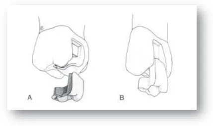 Figure 2 : Inlays sur une molaire (A) et une prémolaire (B) 