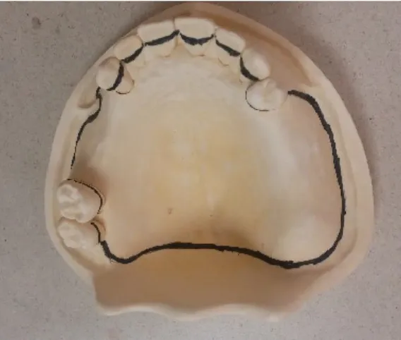 Figure 3 : Syllabus PAPIM UNSA. Tracé des limites de la plaque base maxillaire des maquettes d'occlusion