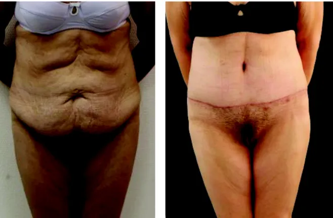 Figure 10 : Abdominoplastie - Pré opératoire Figure 11 : Abdominoplastie - Post opératoire