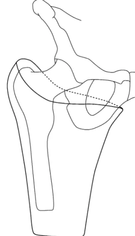 Fig. 4. Amputation fémorale, emboîture avec ischion intégré.