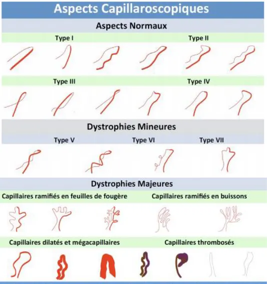 Figure 12 : Classification de la morphologie des capillaires 