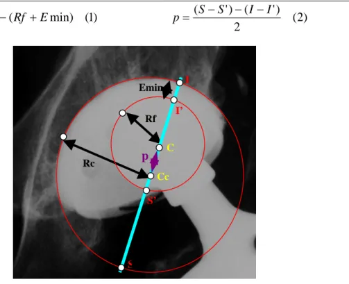 Figure V : Mesure de la profondeur de pénétration sur cliché radiographique