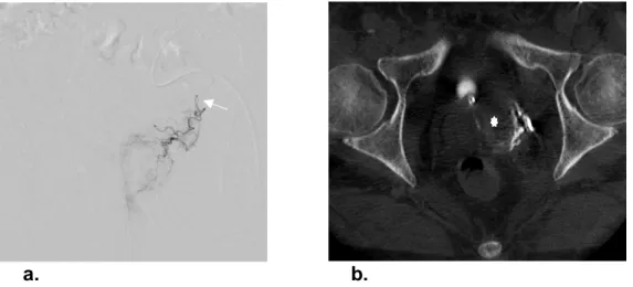 Fig 4: (a) DSA image with microcatheter (arrow) in the left prostatic artery demonstrates large-volume  BPH