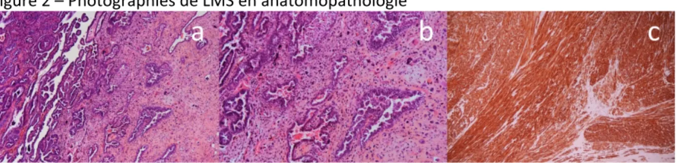 Figure   2   –   Photographies   de   LMS   en   anatomopathologie   