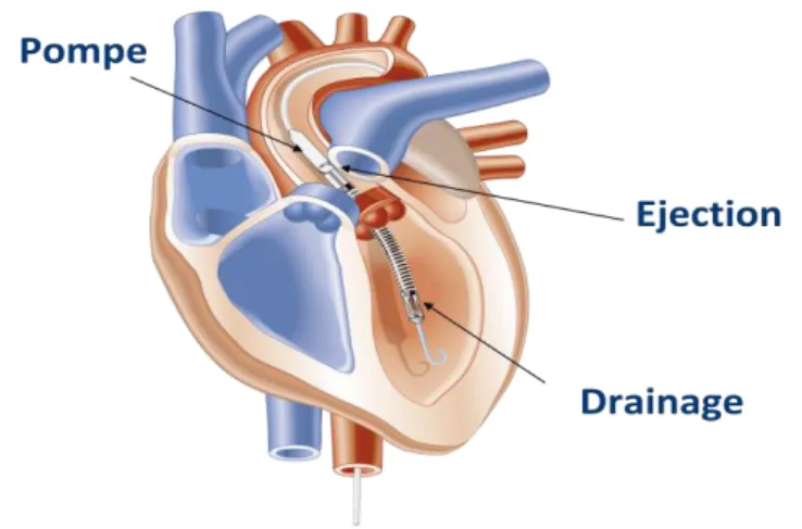 Figure  3 :  b/  Assistance  ventriculaire  gauche  par  le  système  Impella®  (Abiomed)  (www.abiomed.com)