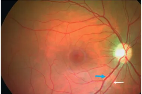 Figure  4  :  Fond  d’œil  normal  avec  visualisation  des  veines  (flèche  bleue)  et  artères  rétiniennes (flèche blanche) (59) 