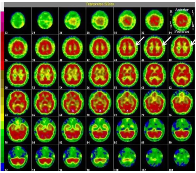 Figure 14 : Imagerie SPECT chez un de nos patients schizophrènes mettant en évidence  une zone d'hypodébit marquée fronto-operculaire gauche (flèche blanche)