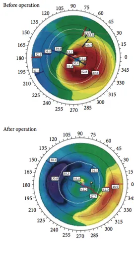 Figure 11 : Exemple de carte kératométrique pré opératoire  (en haut) et post opératoire (en bas) d’AIC