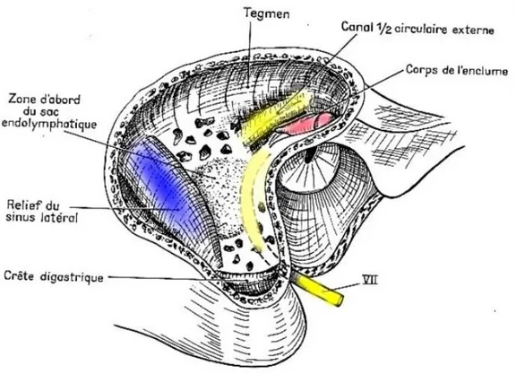 Figure 4 : Mastoïdectomie droite - repérage des structures à risque : nerf  facial en jaune pâle, canal semi-circulaire latéral en jaune, enclume en  rose, sinus sigmoïde en bleu, dure-mère
