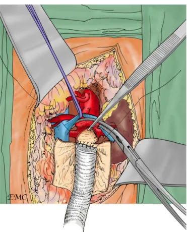 Figure 4: Mise à plat d’un AAAJR et réalisation de l'anastomose  proximale aorto-prothétique  [ 19 ] 
