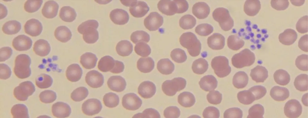 Figure n° 4 : Photographie d’un frottis sanguin en microscopie optique représentant  des amas plaquettaires