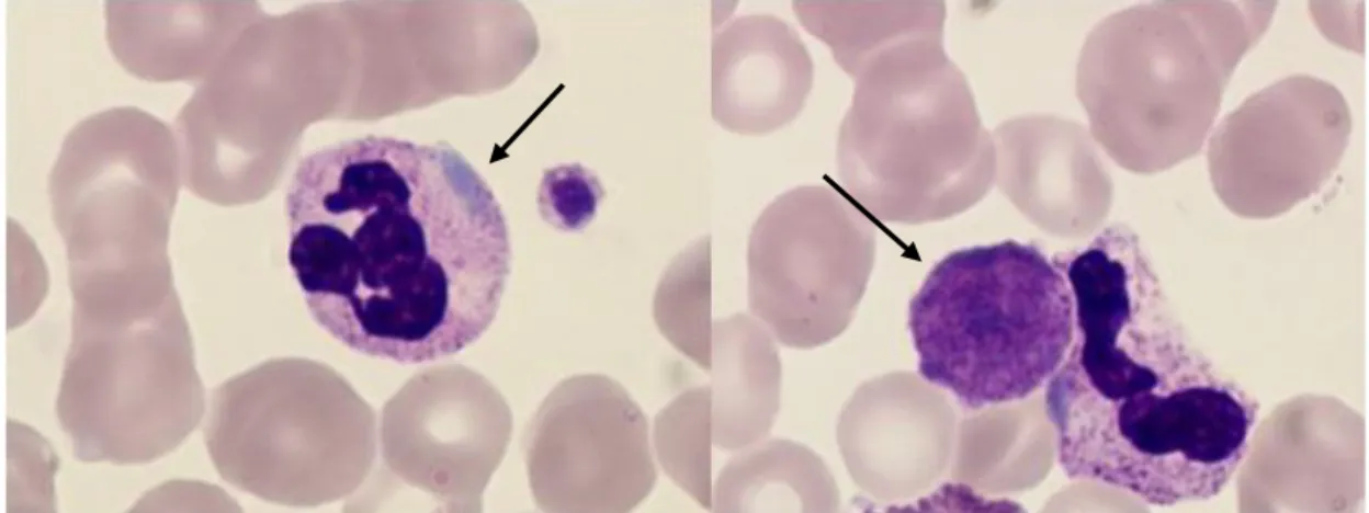 Figure n° 5 : Photographie d'un frottis sanguin en microscopie optique montrant à gauche  un pseudo-corps de Döhle dans le cytoplasme d'un polynucléaire neutrophile, à droite une  plaquette  géante  ayant  une  taille  plus  grande  que  les  hématies