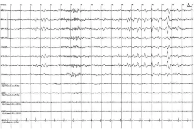 Figure 4  31  : EEG adulte stade 1 