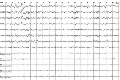 Figure 5  31  : EEG adulte stade 2 