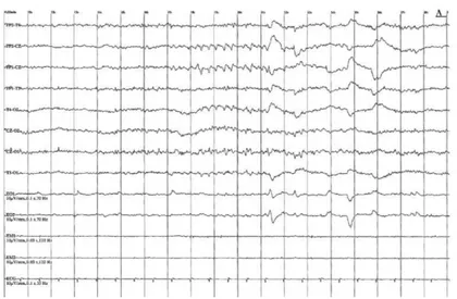 Figure 8  31  : EEG adulte sommeil paradoxal 
