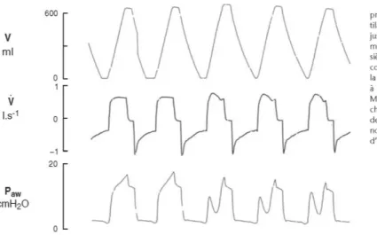 Figure 24  170 : Courbes de volume, de débit et de pression buccale enregistrée au cours d’une ventilation assistée con- con-trôlée 