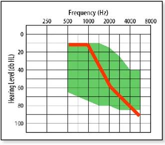 Figure 2 – Critères d’inclusions audiométriques pour l’utilisation du VSB dans  la surdité neurosensorielle, la courbe rouge représentant une courbe de surdité 