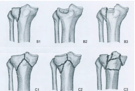 Fig. 12. Classification de l’AO simplifiée des fractures du plateau tibial (9) 