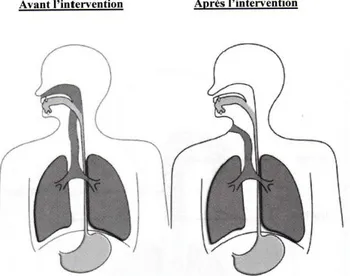 Figure 7 : Modifications  anatomiques  chez la personne  laryngectomisée  totale. D'après  Babin (2011) 