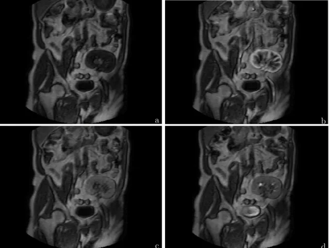 Figure 2.6: Exemple d’acquisition fonctionnelle : coupe d’un greffon rénal réalisée (a) avant injection du gadolinium, puis après l’injection, (b) au temps artériel avec un réhaussement cortical, puis (c) au temps tissulaire avec un réhaussement de l’intég