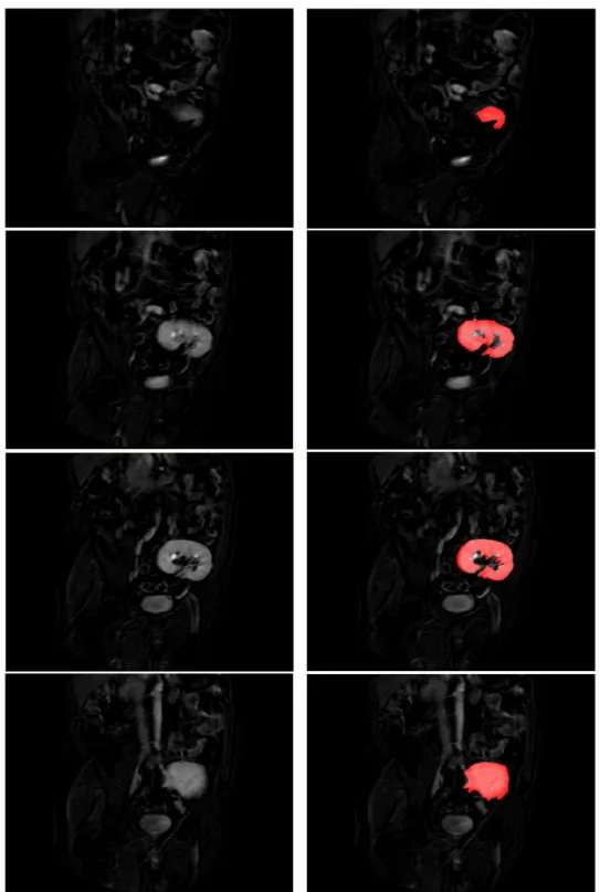 Figure 3.1: Exemple de segmentation manuelle du parenchyme rénal. La colonne de gauche représente les images brutes (aire sous la courbe du signal), la colonne de droite les résultats des segmentations (en rouge) superposés aux images de la première colonn