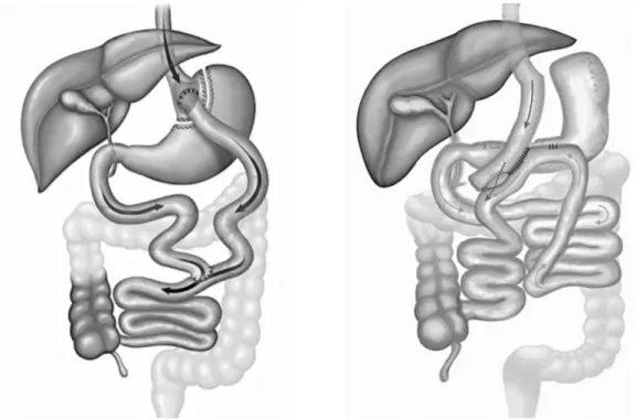 Figure 2 : chirurgies mixtes : bypass gastrique en Y selon Roux ; bypass en Oméga 