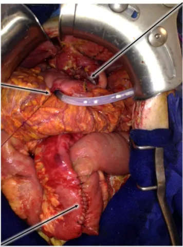 Figure 6 : vue per-opératoire retrouvant l’anastomose gastro-gastrique ; la gastrostomie  d’alimentation et l’anastomose jéjuno-iléale 