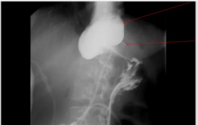 Figure 9 : TOGD pré-opératoire retrouvant une dilatation de la poche gastrique en amont de  l’anneau gastrique ajustable