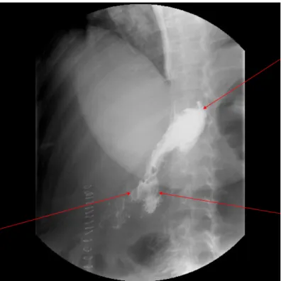 Figure 12 : TOGD après réfection de l’anastomose gastro-jéjunale retrouvant une  opacification gastrique et des deux jambages de l’anse montée 