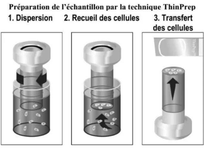 Figure 6. Préparation de l’échantillon par la technique ThinPrep (46) 