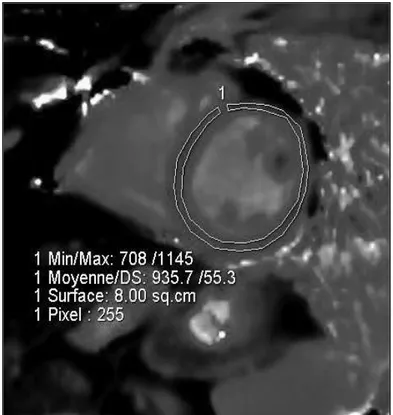 Figure 12 : Séquence T1 mapping petit axe médio ventriculaire. 