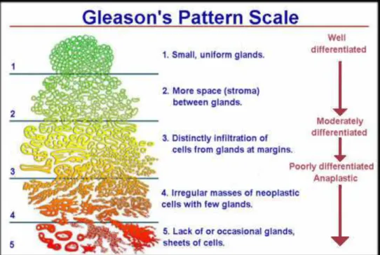 Figure 3 : représentation histologique du score de Gleason 