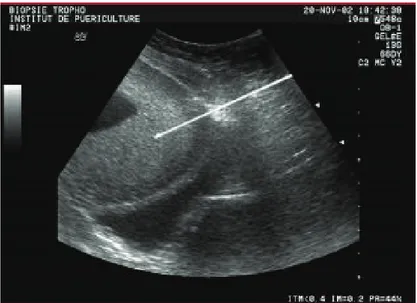 Figure 6 : Image échographique d’une biopsie de trophoblaste 
