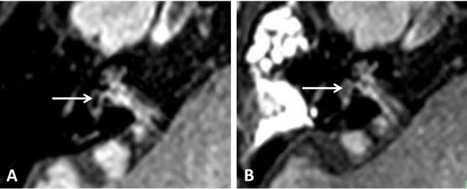 Figure 3 : Changes in MR images after endolymphatic sac decompression (ESD). 3D-FLAIR sequences in the axial slice