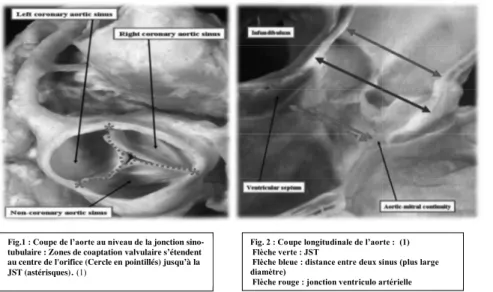 Fig. 2 : Coupe longitudinale de l’aorte :  ! (1) 