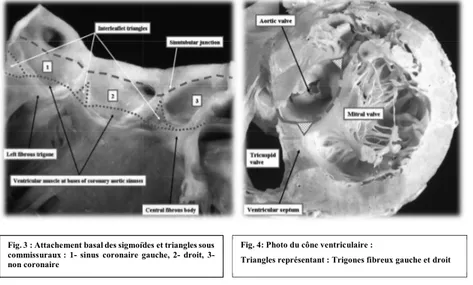 Fig. 3 : Attachement basal des sigmoïdes et triangles sous  commissuraux :  1-  sinus  coronaire  gauche,  2-  droit,  3-   non coronaire 