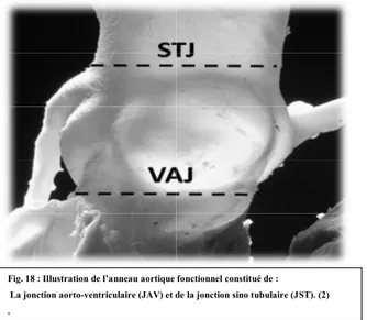 Fig. 18 : Illustration de l’anneau aortique fonctionnel constitué de :   La jonction aorto-ventriculaire (JAV) et de la jonction sino tubulaire (JST)