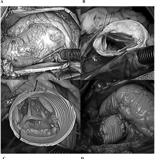 Figure 25 : Illustration par des photos chirurgicales de la procédure de T. David I  A : Anévrysme de la racine aortique et de l’aorte ascendante chez une femme  de 32 ans avec  un syndrome de Marfan