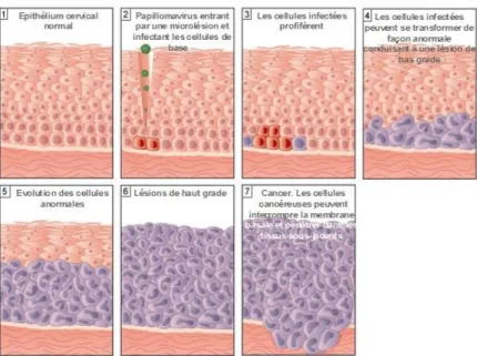 Figure 2: Histoire naturelle du cancer du col de l’utérus: (26) 