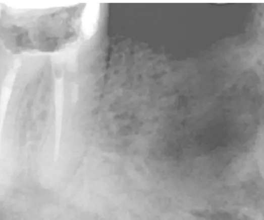 Figure 11: Remodelage osseux post extractionel à 6 semaines post opératoire 