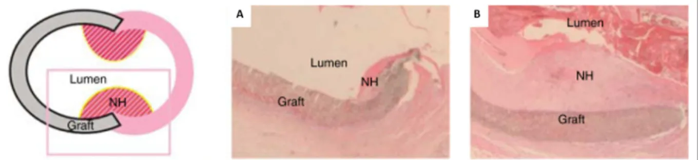 Figure 1.5 Schématisation et aspect histologique de l’hyperplasie néointimale (NH) au niveau  d’une anastomose après (A) 14 jours et (B) 28 jours d’implantation d’une prothèse ePTFE 