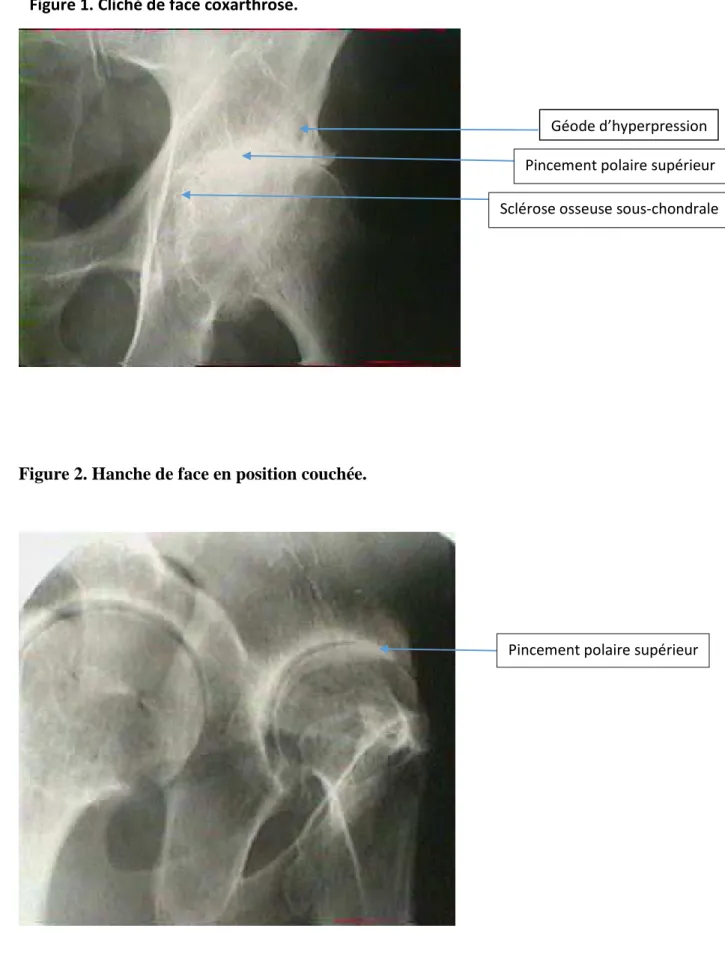 Figure 1. Cliché de face coxarthrose. 