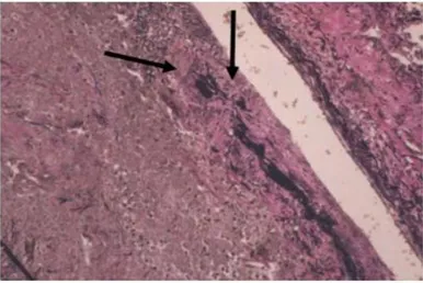 Figure 2 : Cellules géantes multinuclées 