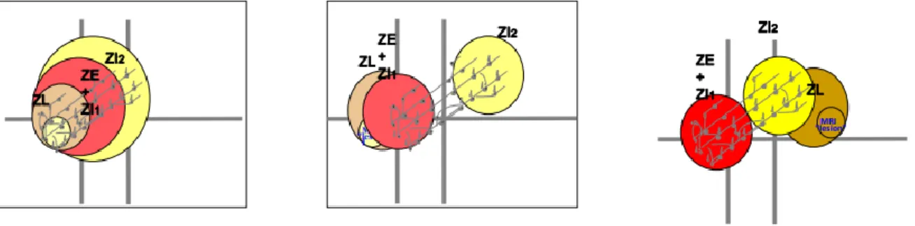 Figure 1 | Illustration   27   montrant différents exemples de configuration entre la ZE, ZL, ZI1 (zone irritative primaire), ZI2  (Zone  irritative  secondaire)
