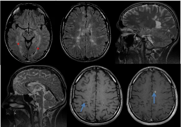 Figure  4  :  Images  IRM  d’ADEM :  Atteinte  de  la    SB  centrale  et  sous  corticale    supra  tentorielle,  en  hypersignal  T2  (*),  de  contours    flous  (b,c,d),  avec  prise  de  contraste  hétérogène  (e)  (),  en  hypersignal  diffusion  (f