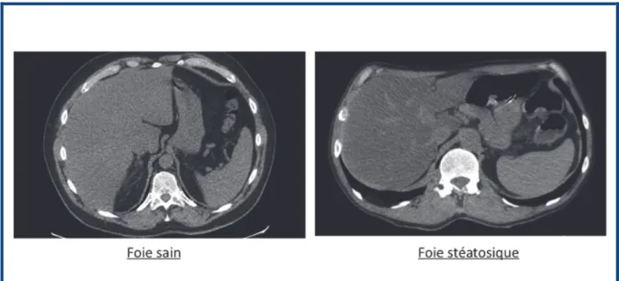 Figure 4. TDM abdominal sans injection montrant un contraste normal sur  foie sain et un aspect de faux contraste spontan€ des vaisseaux sur foie  st€atosique