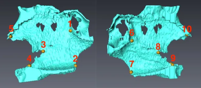 Figure 5. Position des points repères sur septums nasaux osseux et muqueux : vue de face,  vue latérale droite et gauche 