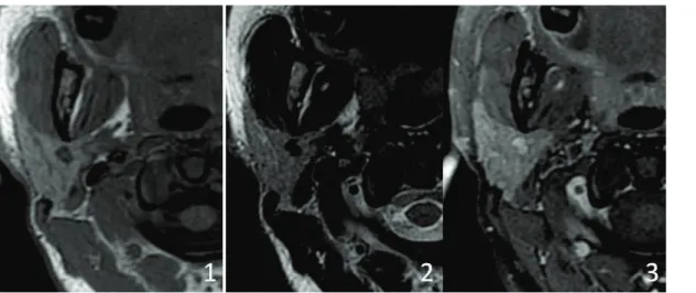 Figure 5 : Radio-anatomie IRM de la parotide 