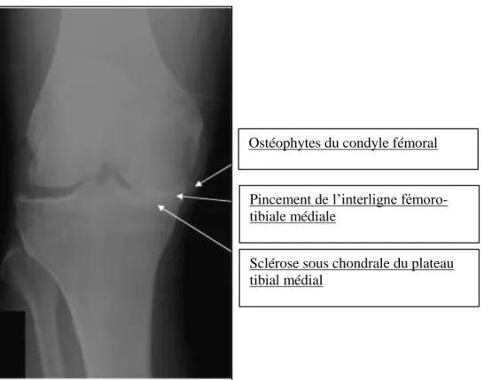 Figure  6 :  Radiographie  de  genou  visualisant  des  ostéophytes  du  fémur,  un  pincement  de  l’interligne et une sclérose sous chondrale 