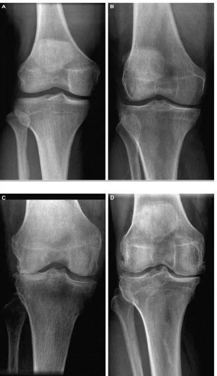 Figure  7:  Radiographies  de  genoux  montrant  les  stades  OARSI  de  classification  des  ostéophytes  